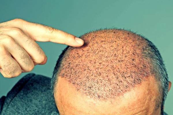 تشخيص وعلاج العدوى بعد زراعة الشعر
