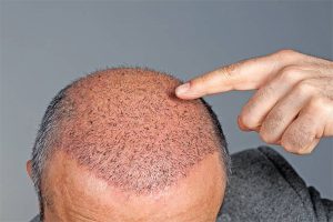 نصائح للعناية بعد زراعة الشعر
