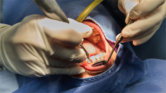 علاج جذر الأسنان في إيران