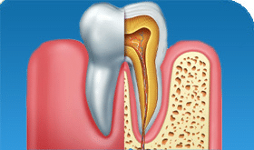 إعادة علاج قناة جذر الأسنان في إيران
