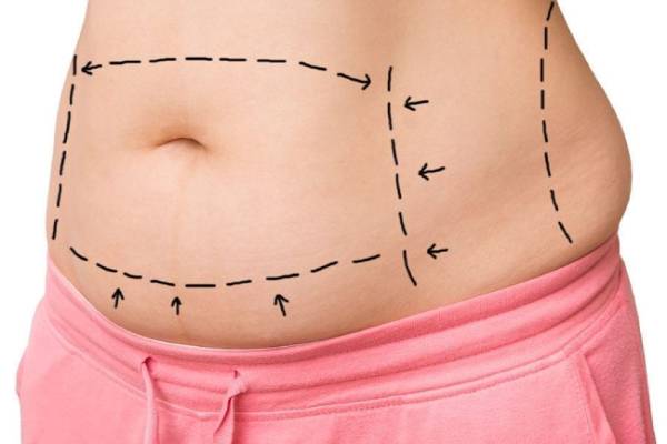 جراحی شکم با ابدومینوپلاستی بهتر است یا پانیکولکتومی؟