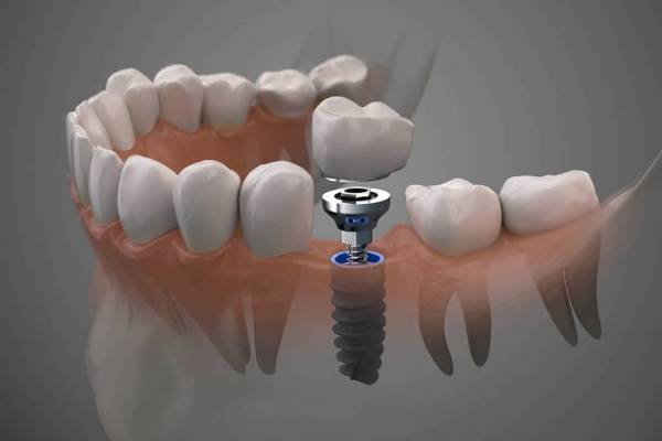 مزایا و عوارض احتمالی ایمپلنت دندان