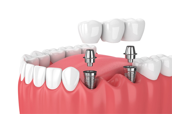 هزینه و نتیجه جراحی ایمپلنت دندان