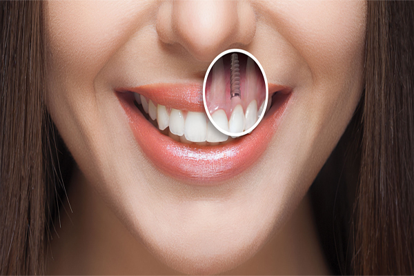 مراحل درمان ایمپلنت دندان