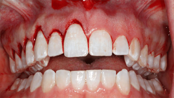 افزایش طول تاج دندان در ایران