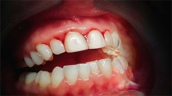 افزایش طول تاج دندان در ایران
