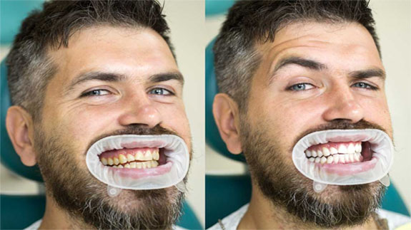 بلیچینگ دندان در ایران