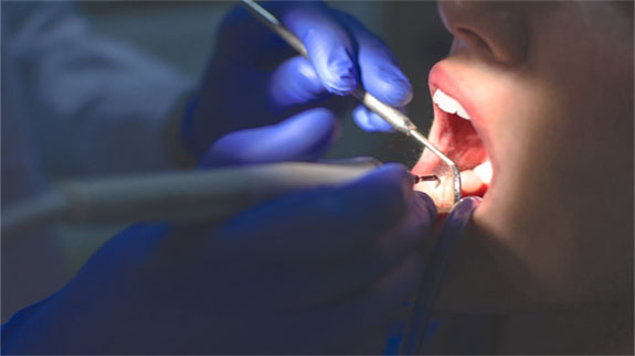 درمان مجدد ریشه دندان در ایران