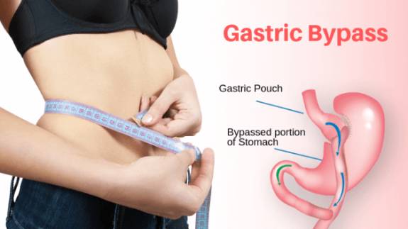 Tips gastric bypass surgery