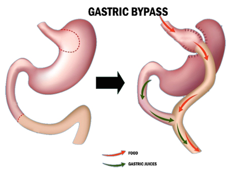 Gastric bypass in iran