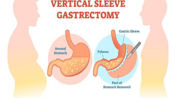Cost of Gastric Sleeve surgery