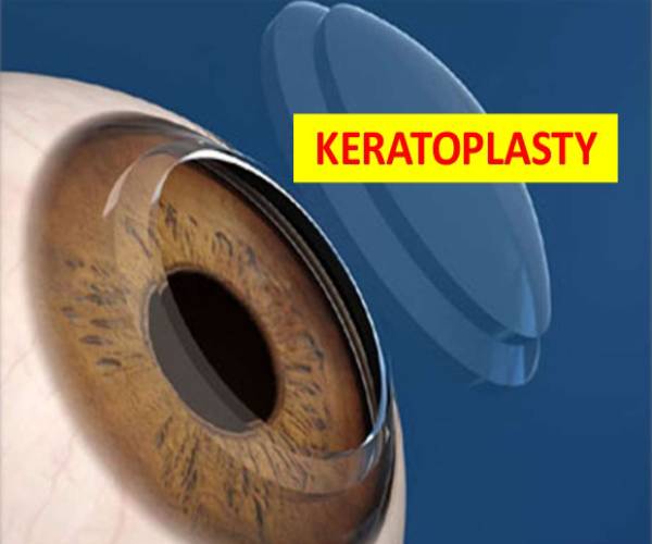 About Cornea transplant (Keratoplasty)