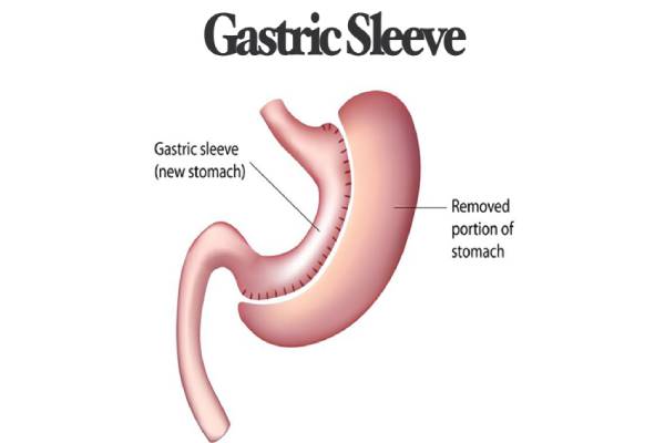 Gastric Sleeve Surgery in Iran