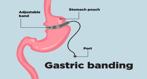 Gastric Banding