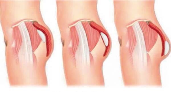 Buttock Prosthesis