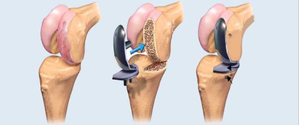 Knee Replacement in Iran