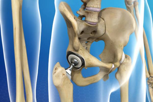 Hip Replacement Questions