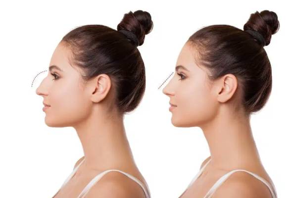 Some points after Rhinoplasty surgery