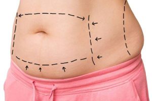 Is Abdominoplasty Better or Paniclectomy