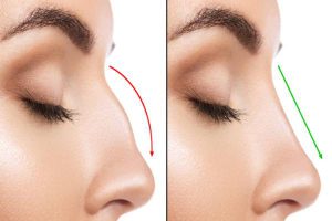 The difference between open and closed rhinoplasty