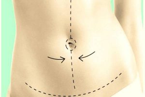 Questions related to abdominoplasty surgery