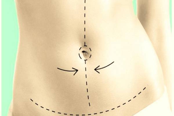 Questions related to abdominoplasty surgery