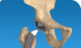 Hip Replacement in Iran