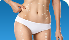 Liposuction in Iran