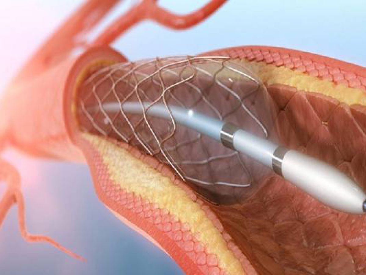 Everything You Need to Know About Angioplasty - Amitis Med Tour