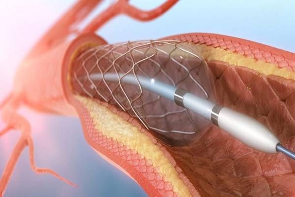 Everything You Need to Know About Angioplasty