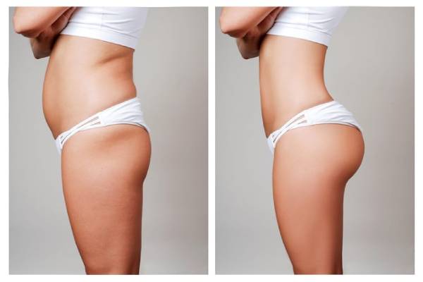 Pros & Cons of Buttocks Prosthesis