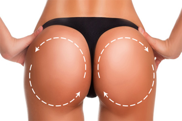 The Cost of Buttock Implants in Iran