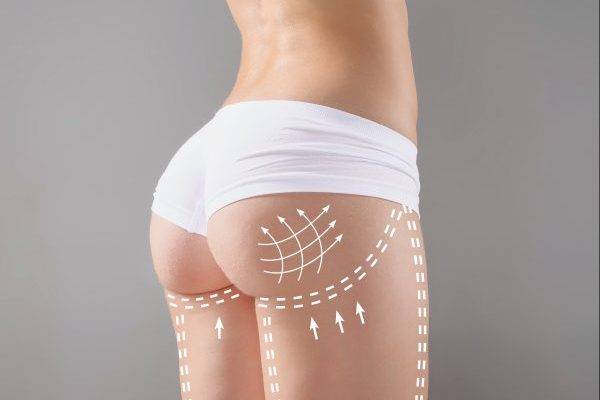 Everything About Buttocks Implants