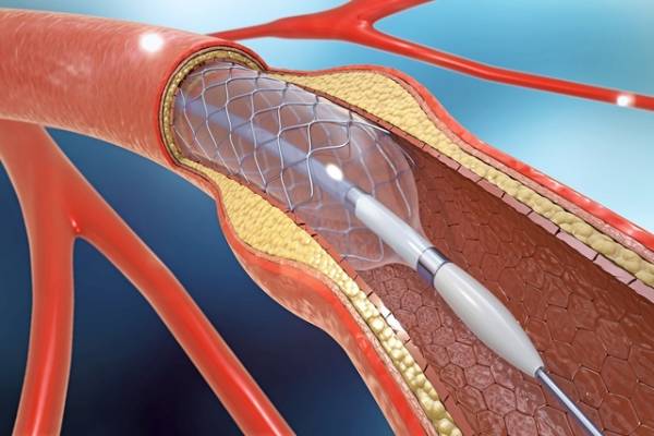 The Cost of Angioplasty