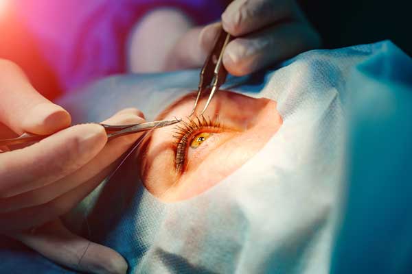 Cost, outcome and FAQs of LASIK surgery