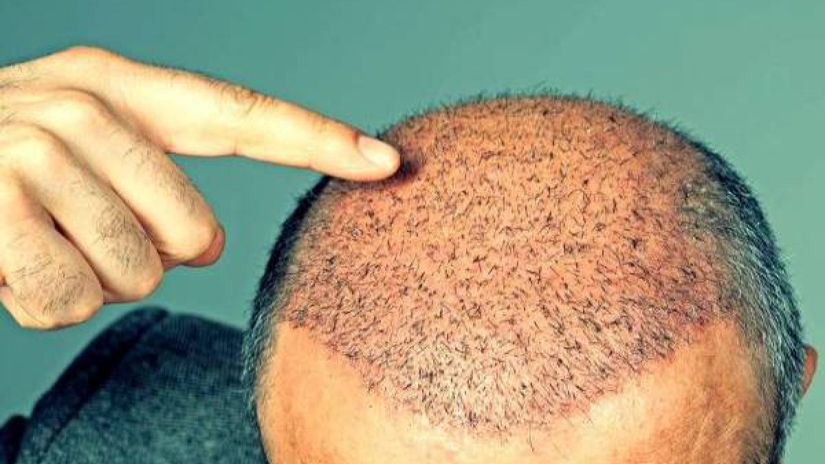 Everything About Hair Transplant: FREE WEBINAR..!! | Opting for a hair  transplant can be a very big decision and you are bound to have a lot of  questions about the after effects