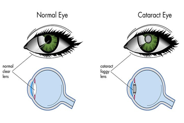 Cataract Surgery Pre & Post-Operative Care