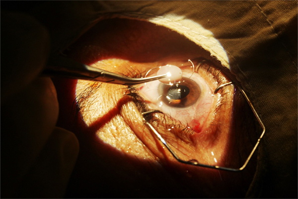 Contraindications to Cataract Surgery