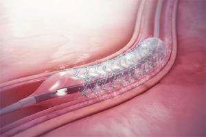 Pre- and Post-Operative Instructions for Angioplasty
