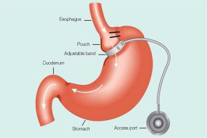 Gastric Banding Surgery: Pros & Cons