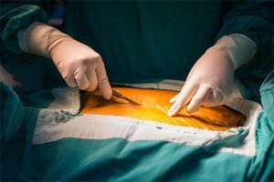 Pros & Cons of Gastric Bypass Surgery
