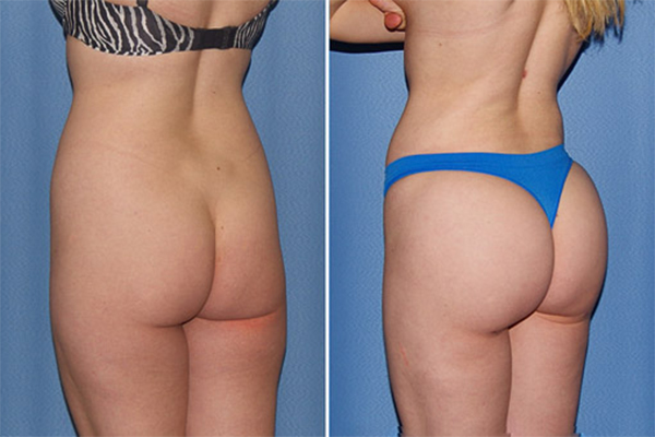 Types of Buttock Prosthesis