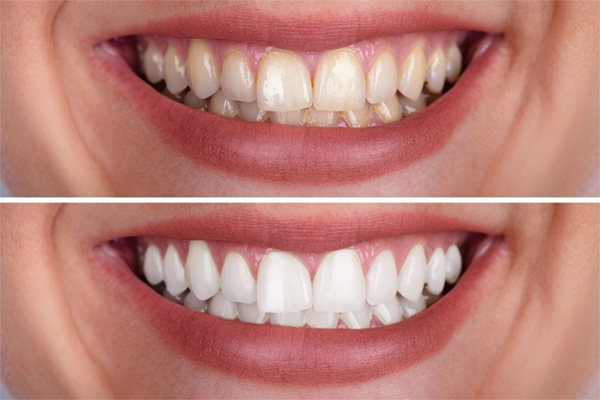 Tooth bleaching; Advantages and Disadvantages