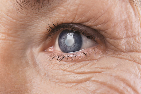 Complications of Cataract Surgery