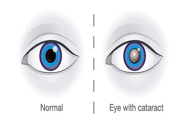 Complications of Cataract Surgery