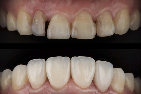 Advantages and disadvantages of dental composite