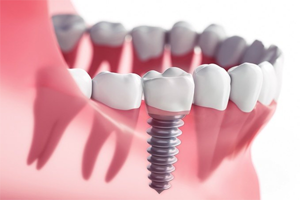 Dental Implantation FAQ