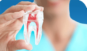Root canal therapy in Iran