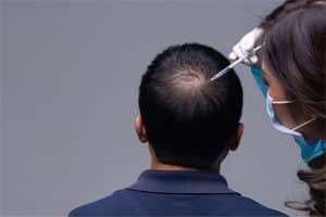 The latest method of hair transplantation in Iran