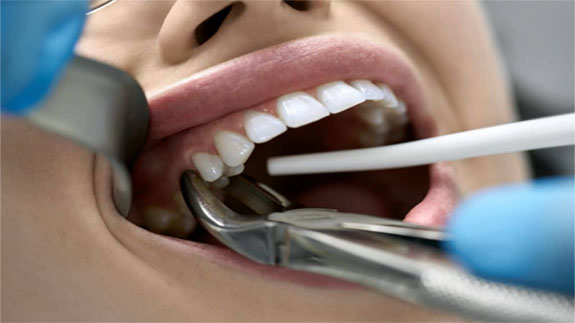 Dental extraction in Iran